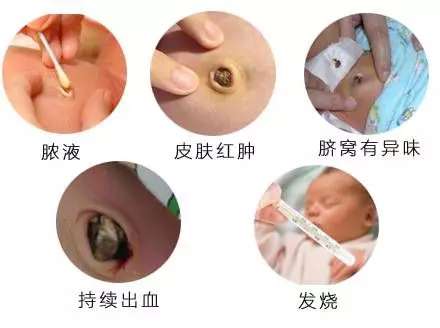 脐带怎么样消 毒？应该注意什么事项？